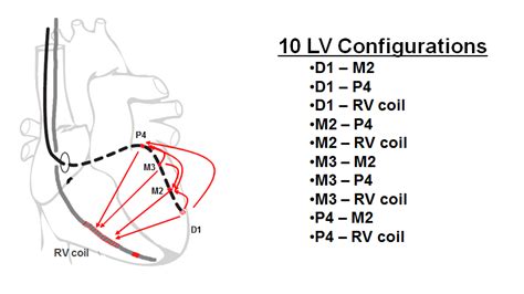 lv2 lv3 lv maturità|Left ventricular stimulation .